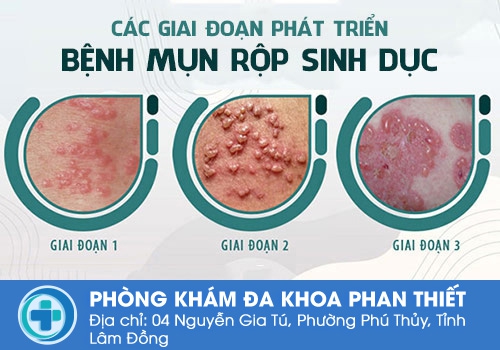 Nguyên nhân gây mụn Herpes ở miệng, môi