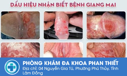 Hình ảnh bệnh giang mai.