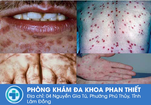 Hình ảnh về bệnh giang mai