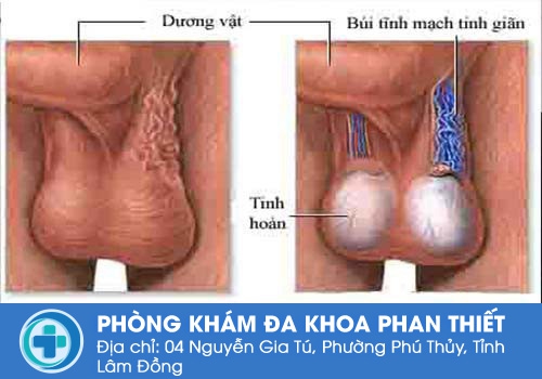 Hình ảnh về giãn tĩnh mạch tinh hoàn