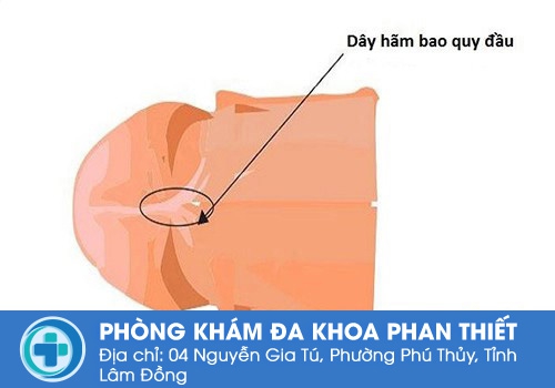có nên cắt dây hãm bao quy đầu không?