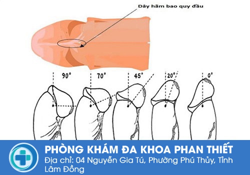 Tuỳ mỗi người sẽ có cấu tạo dây hãm bao quy đầu khác nhau