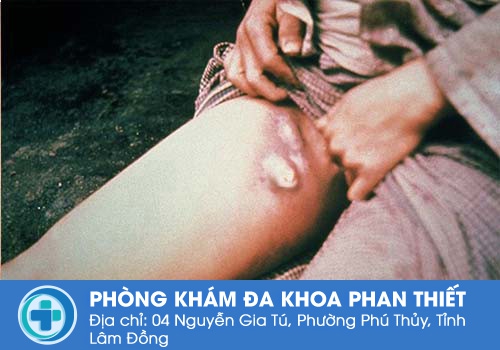 Nổi hạch ở lông mu có nguy hiểm không?