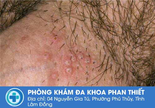 Hình ảnh về bệnh mụn rộp sinh dục