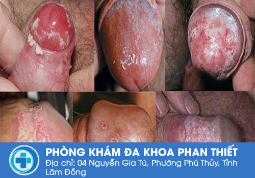 Bựa sinh dục