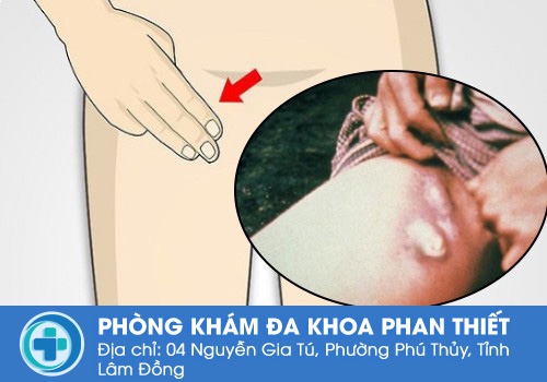 Nổi hạch ở bẹn có nguy hiểm không