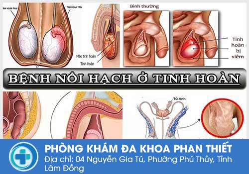 Nguyên nhân bệnh nổi hạch ở tinh hoàn