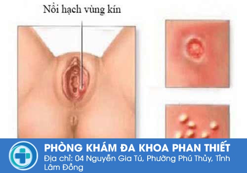 Nổi hạch ở vùng kín nữ