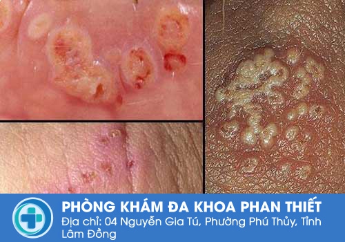 Nổi hạch ở vùng kín nam