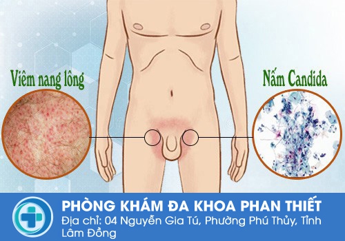 Nguyên nhân bệnh lý khiến vùng háng nam giới bị nổi mụn