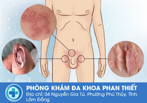 Nổi mụn ở háng cũng không thể thiếu sự