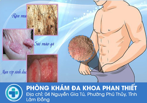 Các nguyên nhân bệnh lý gây nổi mụn ở vùng lông mu nam giới