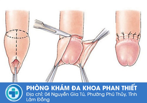 cắt dây hãm bao quy đầu