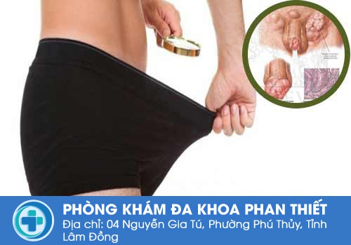 Dương vật nổi hạch là do đâu?