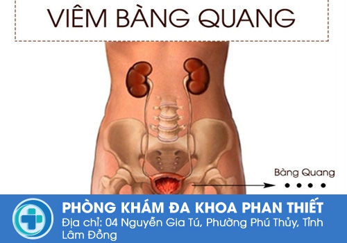 Viêm bàng quang là bệnh gì?