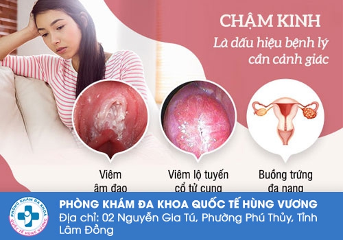 Trễ kinh là dấu hiệu của nhiều bệnh lý phụ khoa.