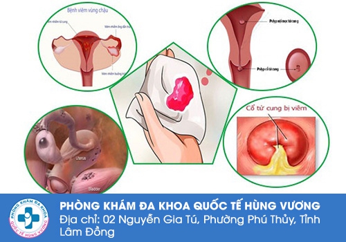 Chảy máu vùng kín là dấu hiệu của nhiều bệnh lý nguy hiểm.