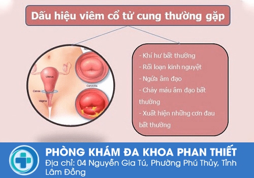 Dấu hiệu của viêm cổ tử cung.
