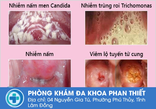 Nguyên nhân dẫn đến tình trạng huyết trắng bột